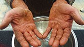 Dry Hands